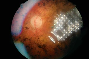 implante retinal 3