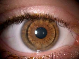 ojo-lentilla