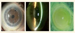 MSK-lentes esclerales-Conoptica