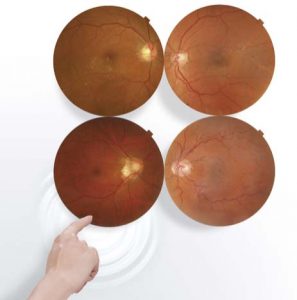 Retina