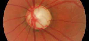 Semana Mundial del Glaucoma